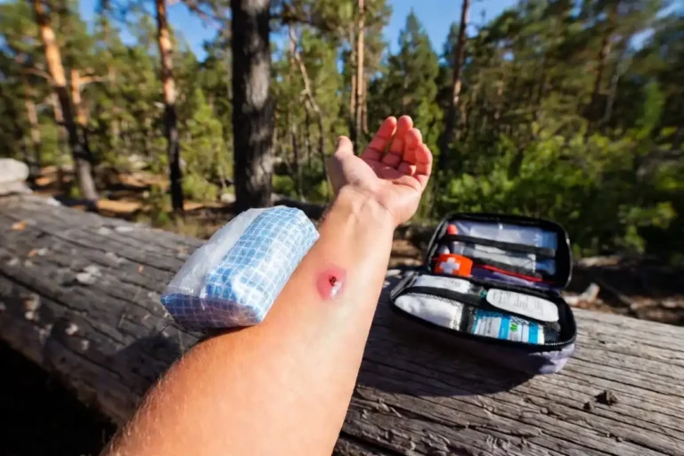 Treat a Bee Sting or Allergic Reaction While Camping