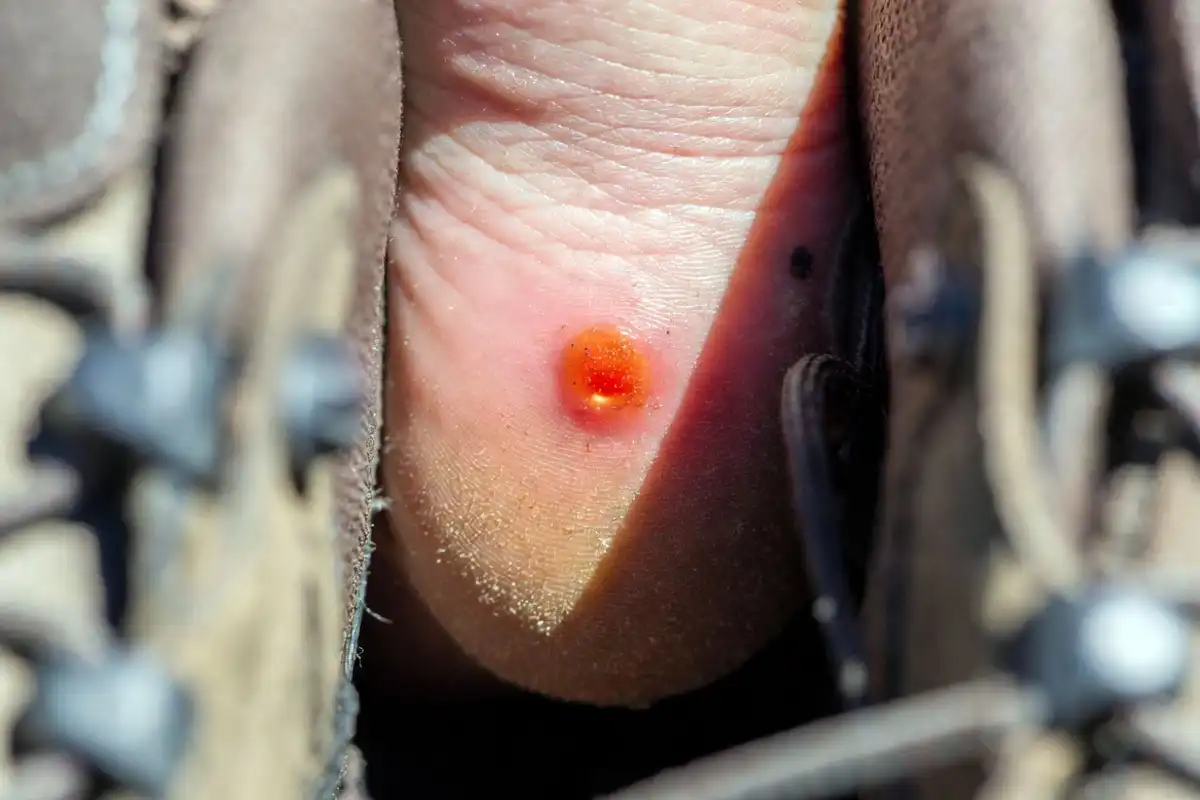 red blister forming on hiker heel from boot friction