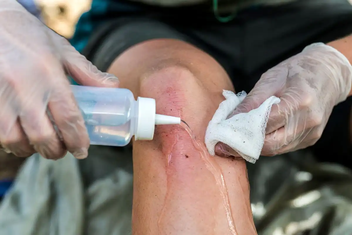 gloved hand rinsing a small knee scrape with treated water