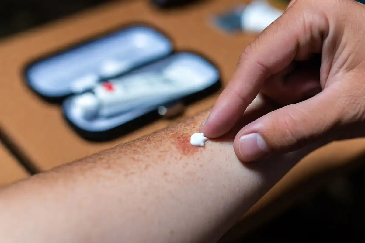 hiker applying anti-itch cream to mosquito bite on arm at outdoor campsite
